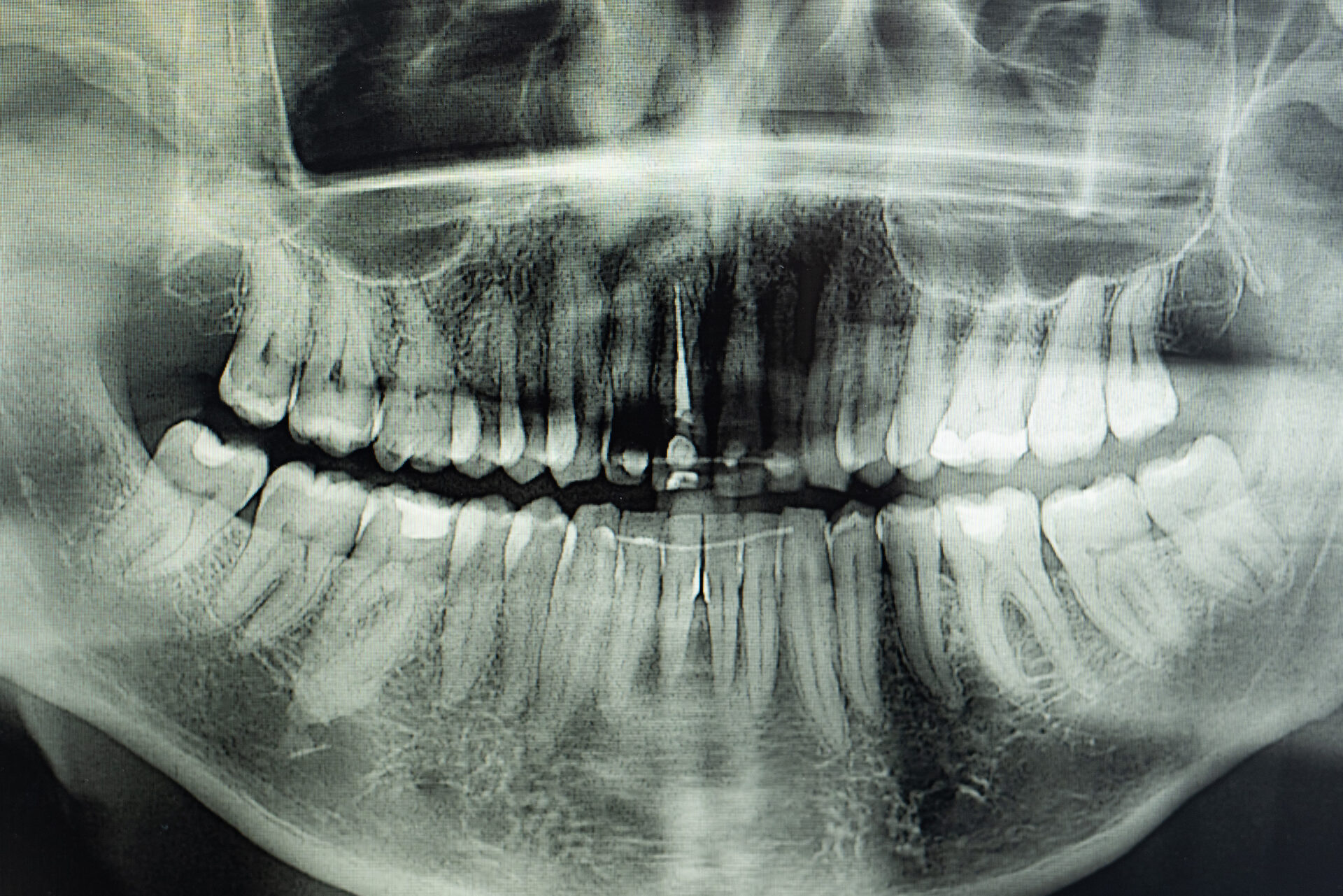 Digital x-ray - impacted wisdom teeth removal East Melbourne - East Melbourne dentist