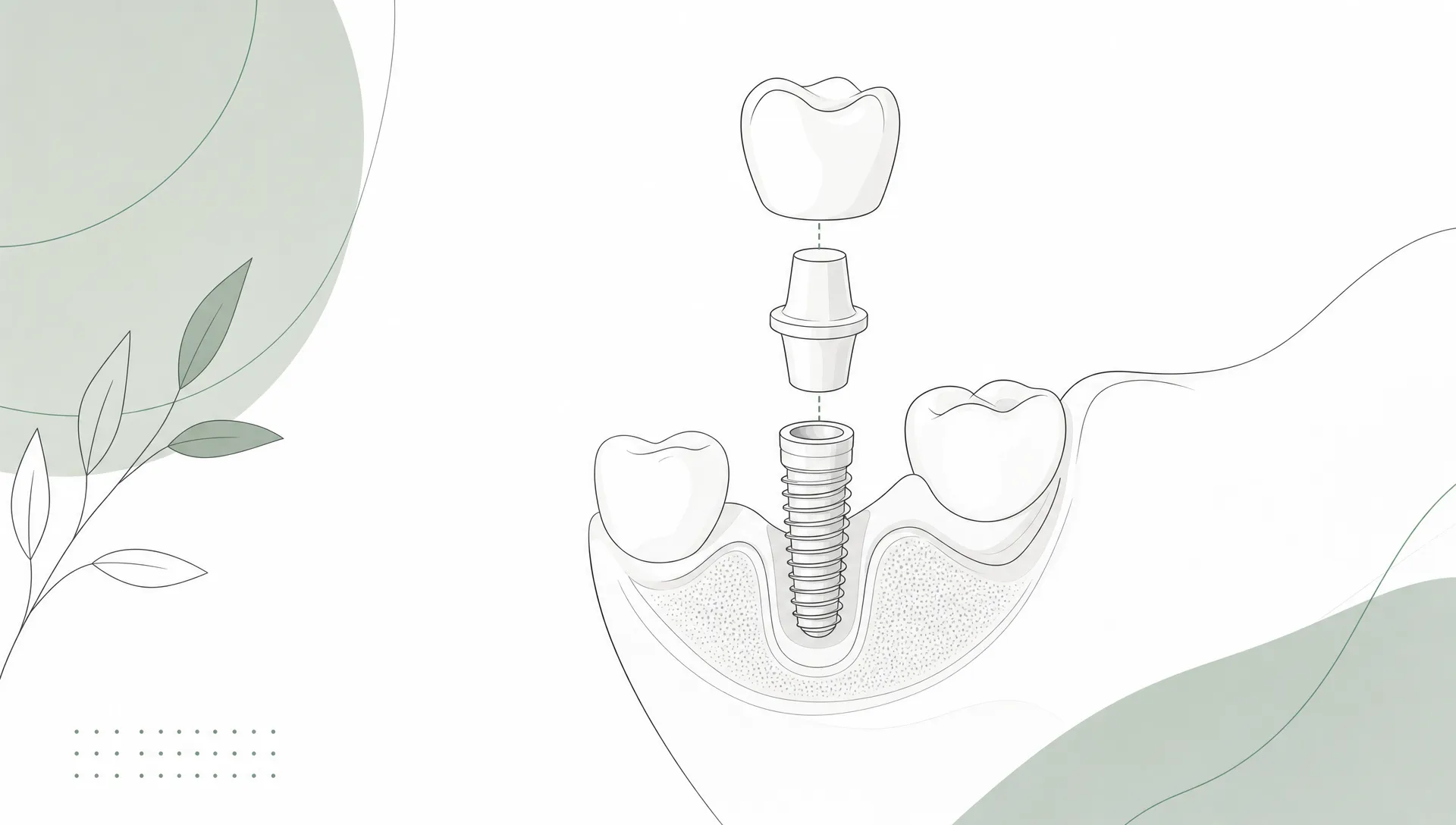 A premium landscape editorial vector illustration of an exploded dental implant showing a ceramic crown, abutment and implant fixture aligned above a simplified jaw, with white forms, charcoal linework, soft grey shapes and restrained sage accents on a spacious white background.
