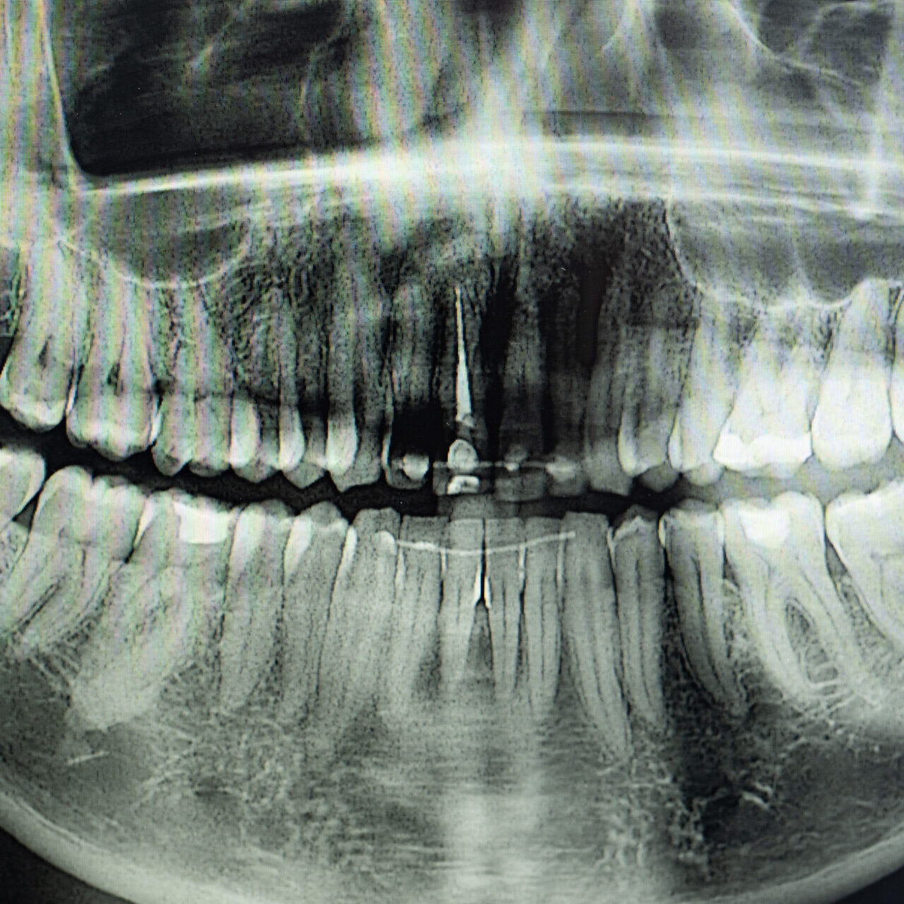 Digital x-ray - impacted wisdom teeth removal East Melbourne - East Melbourne dentist