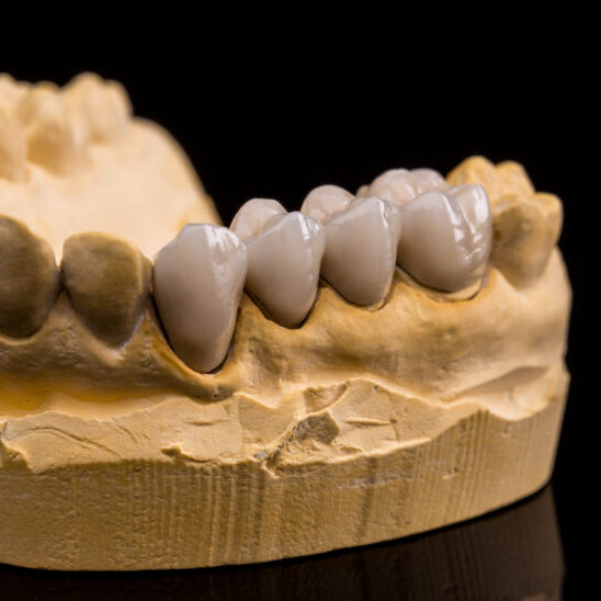 Dental bridge treatment | dental bridge East Melbourne