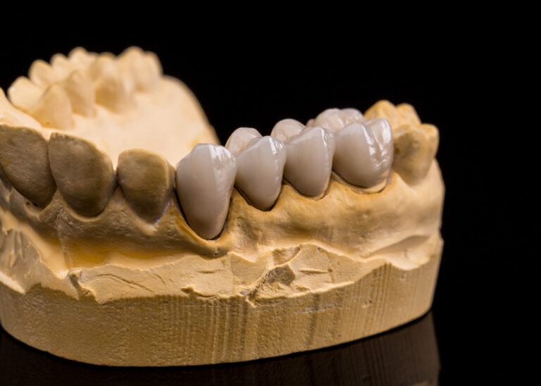 Ceramic Dentures Dental bridge treatment | dental bridge East Melbourne