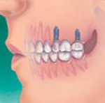Dental Implants 4