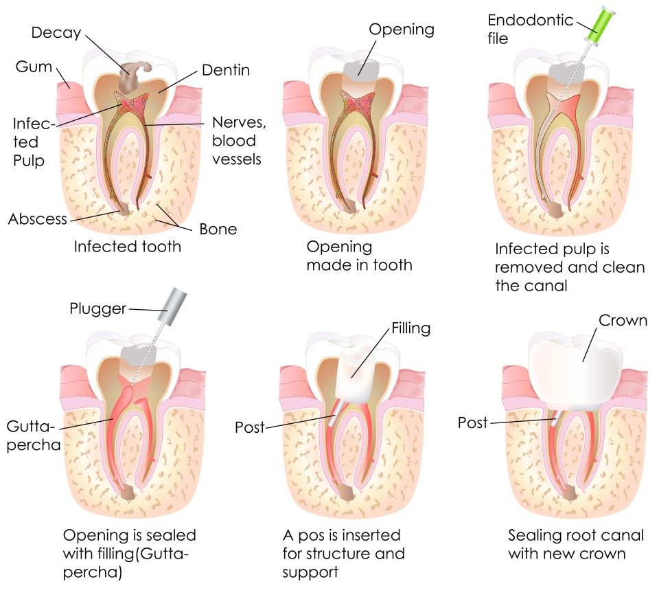 root canal treatment process at East Melbourne Dental Group